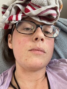 Selfie of flushed face post-surgery.