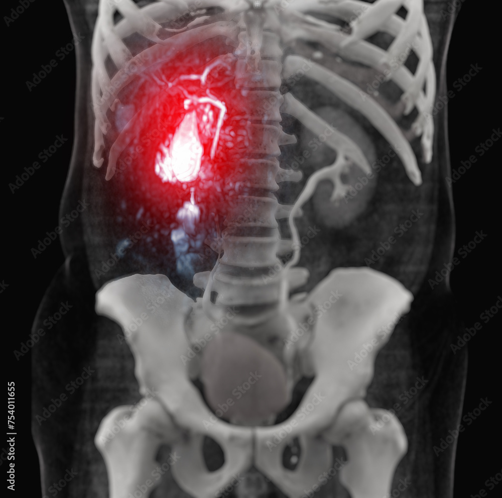 Poster magnetic resonance cholangiopamagnetic resonance cholangiopancreatography.