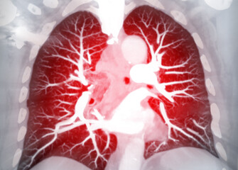 CTPA or CTA pulmonary artery .This imaging technique offers a clear view of the pulmonary arteries, aiding in the diagnosis of pulmonary embolism, vascular conditions, and other respiratory issues.