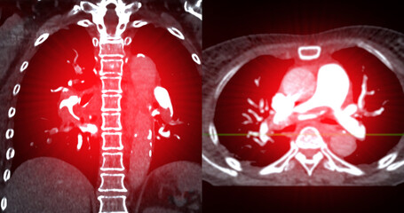 A CTA pulmonary artery reveals a detailed view of the lung blood vessels, capturing the presence of...