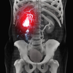 Magnetic resonance cholangiopaMagnetic resonance cholangiopancreatography.