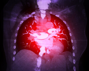 A CTA pulmonary artery reveals a detailed view of the lung blood vessels, capturing the presence of...