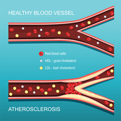 Atherosclerosis. Cholesterol level. Cross section of a Artery with red blood cells, HDL, LDL, and atheromatous plaques