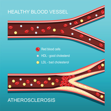 Atherosclerosis. Cholesterol level. Cross section of a Artery with red blood cells, HDL, LDL, and atheromatous plaques