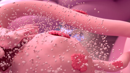 Endometriosis, disease of the female reproduction system