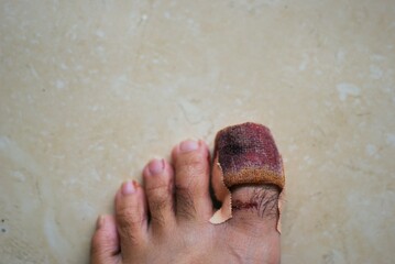 Injured bleeding toe with bandage