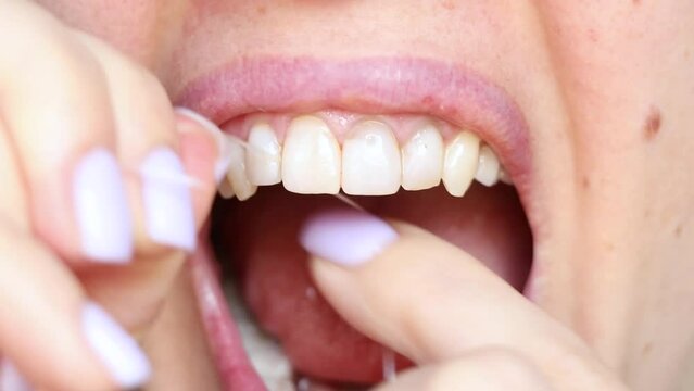 Girl brushes her teeth with dental floss close-up, dental care, no retouching