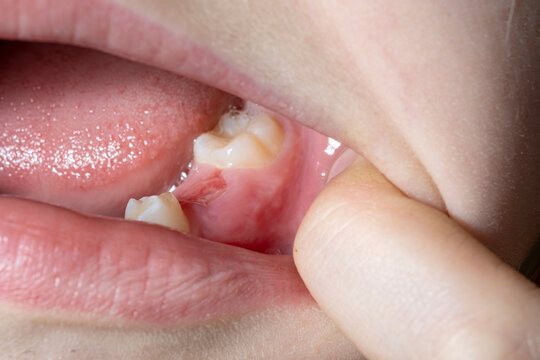 The absence of a baby tooth in a child, a baby tooth has fallen out and the molar is visible.