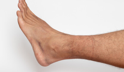 Ankle sprained and bruise contused wound on foot skin on white background.