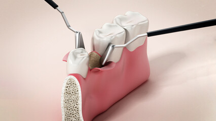 3D illustration of mid-crestal incision dental operation. 3D illustration