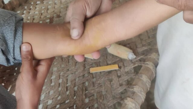 Traditional Pakistani Hakeem Treating Boy's Broken Arm with Herbal Remedy