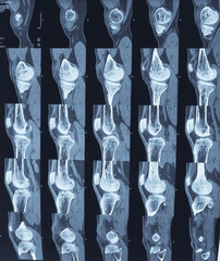 CT scan of Knee joint. knee joint alignment and congruity maintained. Normal findings.