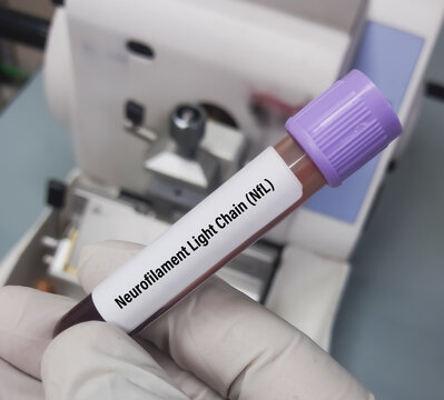 Blood sample for Neurofilament Light Chain(NfL), Plasma test, to diagnosis of Alzheimer's disease. Amyloid-Tau-Neurodegeneration (ATN) Profile.