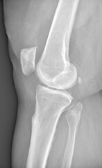 X-ray of the bones of knee of a man. Medical concept.