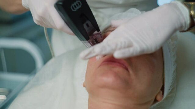 Transforming Skin Health: Microneedle RF System for Non-surgical Facial Lifting and Skin Renewal. High quality 4k footage