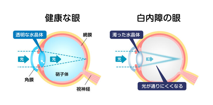 健康な眼と白内障の眼の比較 ベクターイラスト