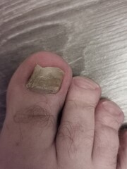 mold on the nail