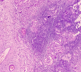 Photo of benign brenner tumor of ovary, showing tumor sheet on the right side and ovarian stroma on...