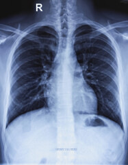 Chest xray PA view film. Normal chest radiograph.