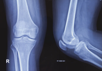 Plain X ray of knee joint both view. Normal finding detected. - obrazy, fototapety, plakaty