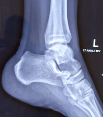 X-ray or radiograph of an ankle showing anatomy of bones and joint of ankle and foot in a patient with ankle sprain.