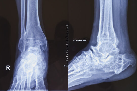 X-ray of ankle joint both view. Diffuse sclerosis at tarsal, metatarsal bones and distal shaft of tibia and fibula with deformed shaped. joint spaces are markedly reduced.