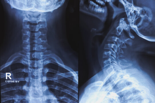 Photo of human neck X-ray image. X-ray of cervical spine ap and lateral view.