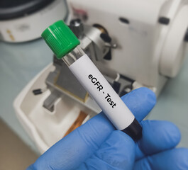 Blood sample for eGFR (Estimated glomerular filtration rate) for diagnosis of renal or kidney disease.