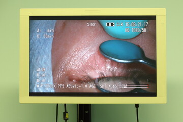 Display with surgery patients eye at the center of endosurgery and lithotripsy