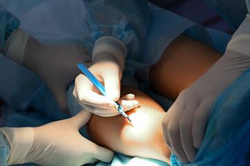 The doctor makes a cut on the leg with a scalpel