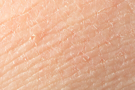 Texture of dry skin as background, macro view