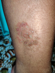 Close up of ringworm on the thigh of Asian man - obrazy, fototapety, plakaty
