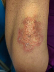 Close up of ringworm on the arm of Asian man