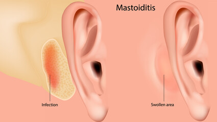Mastoiditis. Inflammation of the mucosal lining of the mastoid antrum and mastoid air cell system inside the mastoid process. Medical - obrazy, fototapety, plakaty