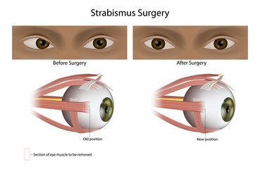 Strabismus or Squint surgery treats misaligned eyes. Eye Muscle Surgery.