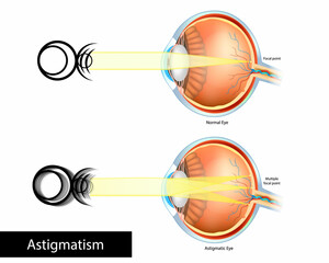 Astigmatic Eye and Normal Eye. Astigmatism, refractive or refraction error. Multiple Focal point.