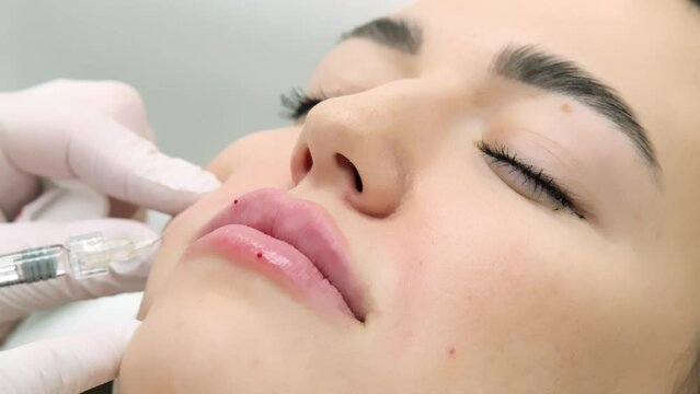 Close-up of a young woman's face undergoing lip augmentation procedure. Cosmetology injections and services. Injection lip correction.