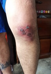 Pierna de una persona con abrasión o herida en la rodilla con signos de infección 