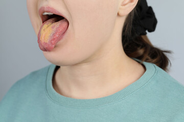 Gastrointestinal diseases. Woman showing her yellow tongue on light grey background, closeup