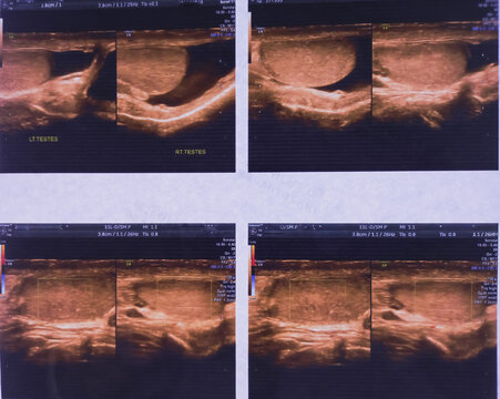 USG of Testes. Smaller both testes and bilateral mild hydrocele. Heterogeneous.