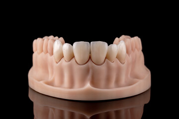 Dental model of teeth on a black background. Six ceramic crowns on silicone gums.