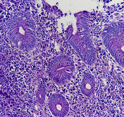 Sigmoid colon (colonoscopic biopsy): Chronic nonspecific colitis. Show colonic mucosa, chronic...