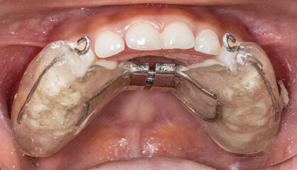 Palatal expander device sealed to widen the upper jaw in orthodontics treatment. Transparent acrylic resin with metal hooks and a check actuator. Directly below view of a young dental patient case.