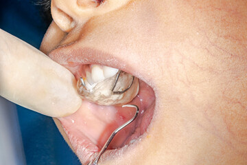 Orthodontics patient kid with a prosthetic device on the maxillary arch, mouth open and a dentist's...