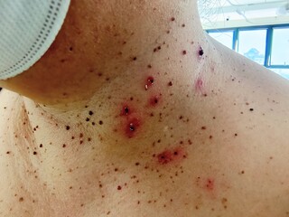 Close up skin tag on woman's neck Symptoms of dermatitis The concept of beauty and health