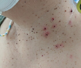 Close up skin tag on woman's neck Symptoms of dermatitis The concept of beauty and health
