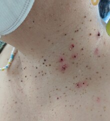 Close up skin tag on woman's neck Symptoms of dermatitis The concept of beauty and health