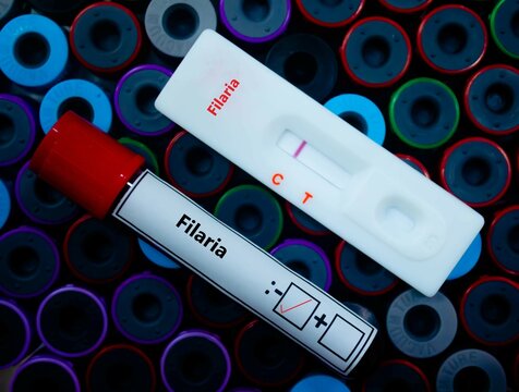 Blood sample of patient negative tested for filaria by rapid diagnostic test.