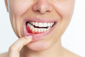Gingivitis, gum inflammation. Cropped shot of a young woman showing red bleeding gums isolated on a...