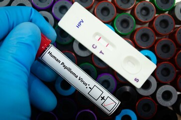 Fototapeta premium Blood sample of patient positive tested for human papilloma virus by rapid diagnostic test.